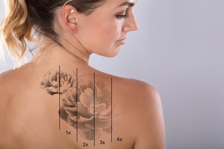 Laser Tattoo Lightening Lexington